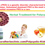 5-Natural-Herbal-Treatments-for-Polycystic-Kidney-Disease