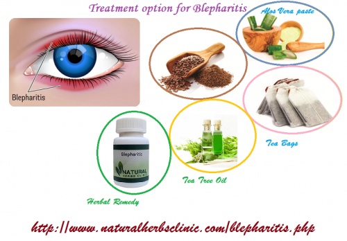 The Blepharitis Treatment begins with thorough eye examination to determine the exact cause of the eyelid inflammation.... http://www.naturalherbsclinic.com/blog/natural-treatment-of-blepharitis-inflammation-of-the-eyelids/