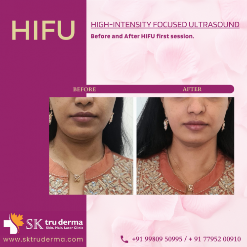 Before-and-After-HIFU-first-session-at-Best-Skin-clinic-in-Sarjapur-Road-sktruderma.png