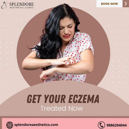 Best treatments for eczema  in HSR Layout |Splendore Aesthetic Clinic Eczema treatment can be complex. There are many types of eczema that all might need a different treatment. However, there may be some self-care and home care practices that you can do to manage your skin and your symptoms.
	https://splendoreaesthetics.com/