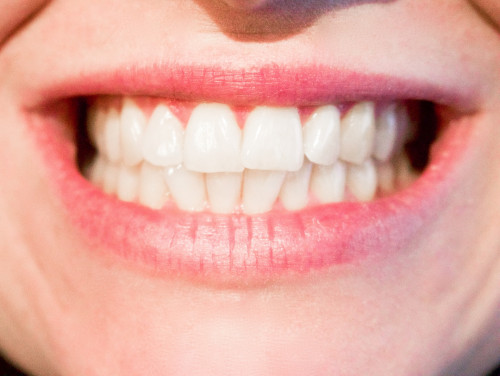 Get the beautiful smile with Dentist NYC for adults  AT  http://www.smilehealthspa.com/our-office/

Find Us: https://goo.gl/maps/gvMQLAu8a9p
Deals in .....
dna appliance for adults cost
Dna appliance
homeoblock for adults cost
Homeoblock
Nyc Cosmetic bonding

Dentist NYC advise parents to take their children to see orthodontist at the earliest signs of orthodontic issues, or by the time they are seven years old. A younger child can achieve more progress with early treatment and the cost is less. If it is determined that early treatment is not necessary, the child can be monitored until treatment is necessary. The growth of the jaw and the facial bones can make a big difference in the type of treatment required.

business name- Irene Grafman DDS - Smile Health Spa
Street Address: 120 East 36th Street ,Suite 1F ,New York, NY 10016
Business Number:  (212)532-5377
Fax# : (212)532-5371
Year Established: 1998
Primary Email Address : docgrafman@aol.com
Hours of Operation: Monday 10-6, Tuesday 10-6, Wednesday 10-6

Social---
https://list.ly/lasdef7
https://profiles.wordpress.org/nycinvisalign/
https://www.ted.com/profiles/10013271