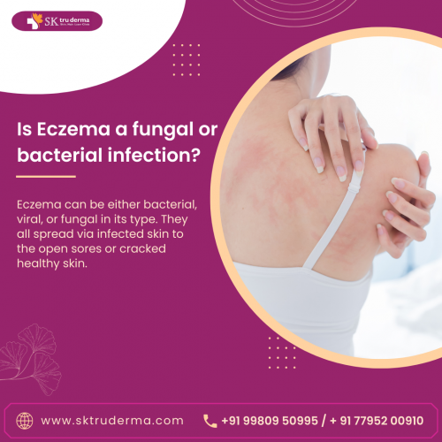 Eczema Fungal or Bacterial Infection, Dermatologist in Sarjapur Road