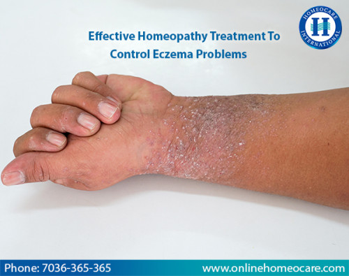 Effective-Homeopathy-Treatment-To-Control-Eczema-Problems.jpg