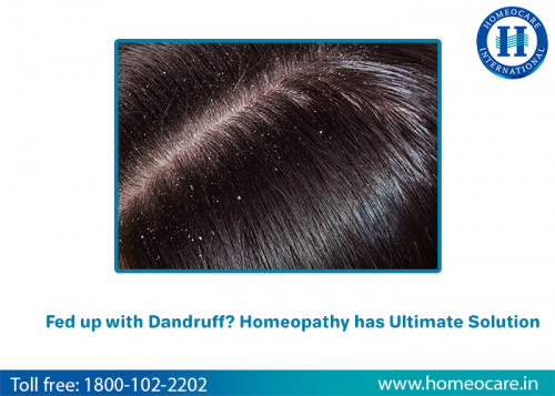 Embarrassed-with-dandruff-Get-Relief-With-Homeopathy-in-Begumpet.jpg