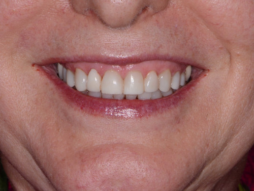 Our Website: http://www.smilehealthspa.com/our-office/
Best cosmetic dentist NYC are highly specialized dentists. Their main focus is on the prevention and treatment of "improper bites". This is an important dental issue, as improper bites can lead to a variety of problems such as tooth irregularities, lop-sided jaws and crooked teeth. Orthodontics was actually the first sub class of dentistry to be recognized as its own specialty field. Generally speaking, it takes two to three years of extra schooling after graduating as a dentist to earn the qualifications to become an orthodontist.
More Links: 
https://nycinvisalign.shutterfly.com/pictures/22
https://nycinvisalign.shutterfly.com/pictures/21
https://nycinvisalign.shutterfly.com/pictures/20
http://online.fliphtml5.com/dvysq/eqlp/