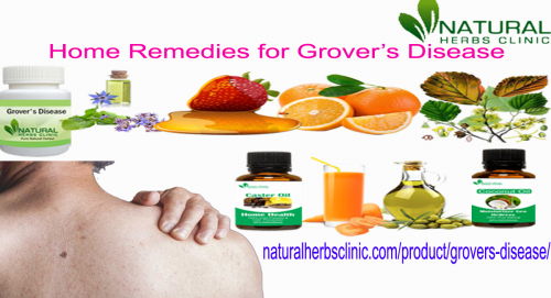 Grovers-Disease-Natural-Treatment-at-Home.png