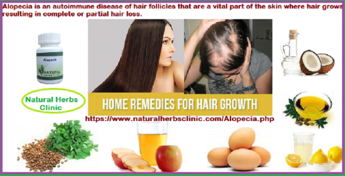 By taking advantage of what Mother Nature has to offer, you can see some great improvements in hair growth. Natural Treatment for Alopecia has staked their claim in the hair loss world as well.... https://herbsmedication.tumblr.com/post/167545743919/hair-growth-solutions-for-fighting-alopecia