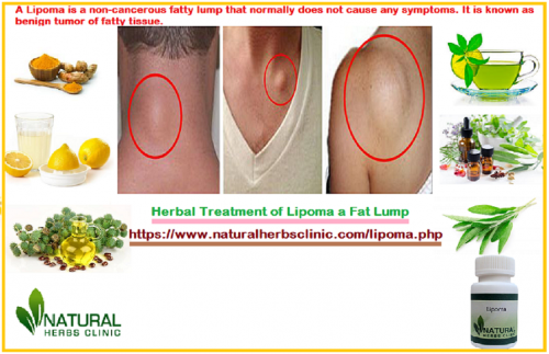 There are various accounts of people having a lot of success influencing the size and number of lipomas on their body using Lipoma Herbal Treatment.... http://www.naturalherbsclinic.com/blog/herbal-treatment-of-lipoma-a-fat-lump/