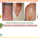 Herbal-Treatment-of-Lipoma-a-Fat-Lump