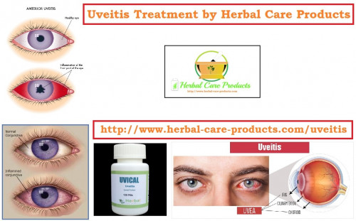 As much as the medical remedies are the first few options to explore to treat uveitis, there are also Home Remedies for Uveitis to consider. The natural home remedies help to control the most common symptoms of uveitis, but they are useless when you experience the severe symptoms:
https://www.herbal-care-products.com/blog/uveitis-natural-remedies-symptoms-causes-and-home-treatment/