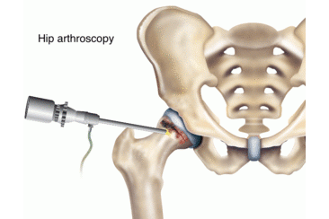 Hip-Arthroscopy.gif