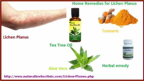Home-Remedies-for-Lichen-Planus.png