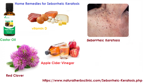 Though, it is important that a person knows that if they choose to use Home Remedies for Seborrheic Keratosis then the results may take longer to show as contrast to commercial or scientific treatment... https://naturalcureproducts.wordpress.com/2018/05/18/home-remedies-for-seborrheic-keratosis/