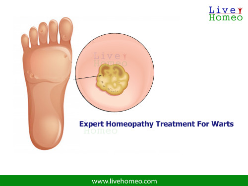 Homeopathy-Clinics-for-Warts-Treatment-In-Jayanagar.jpg