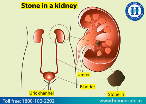 Homeopathy-Treatment-For-Kidney-Stones.jpg