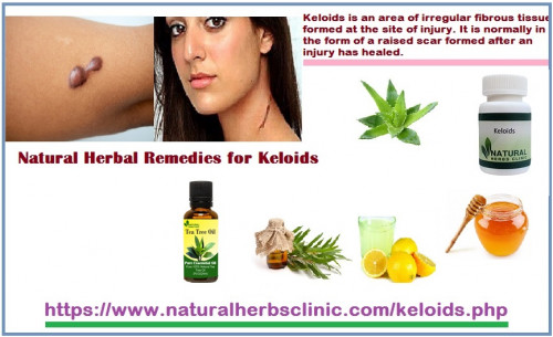 How-to-Improve-Keloid-Scars-With-an-All-Herbal-Treatment.jpg