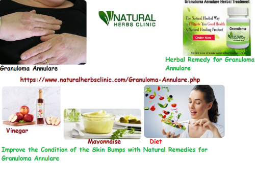 Diet plays a vital role in Natural Remedies for Granuloma Annulare. Avoid eating sweets and fatty food. Eat rich in minerals healthy diet, fibers, and vitamins... https://www.godry.co.uk/profiles/blogs/natural-remedies-for-granuloma-annulare-improve-the-condition-of