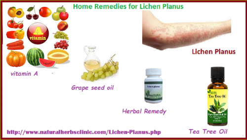 Natural-Home-Remedies-for-Lichen-Planus.png