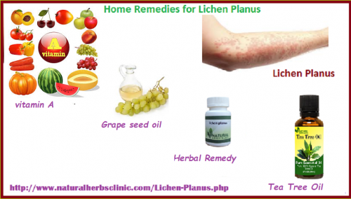 It would be more correct to call it as a treatment instead of a ‘cure’. Here are some of the Natural Remedies for Lichen Planus that people have found most effective.... https://herbscareclinic.kinja.com/natural-home-remedies-for-lichen-planus-1826217524