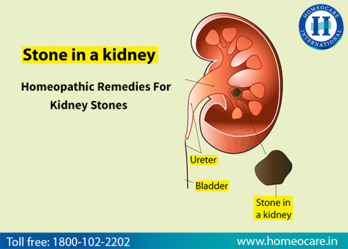 Natural-Homeopathy-Treatment-For-Kidney-Stones-in-Nizamabad.jpg