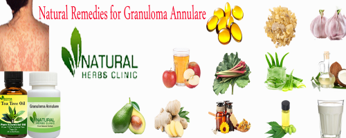 Natural-Remedies-for-Granuloma-Annulare.png