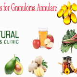 Natural-Remedies-for-Granuloma-Annulare