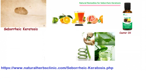 If it is constantly there and the individual feels the requirement to remove it, then there are numerous dissimilar Natural Remedies for Seborrheic Keratosis to choose from.... https://www.naturalherbsclinic.com/blog/seborrheic-keratosis-a-fairly-common-skin-lesion/