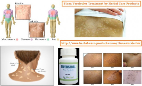 The best Natural Treatment for Tinea Versicolor is using natural home remedies that have being proven over time to clear up Tinea Versicolor both internally and externally. In fact it has no side effects.
https://www.herbal-care-products.com/blog/natural-remedies-for-tinea-versicolor-symptoms-herbal-treatment/