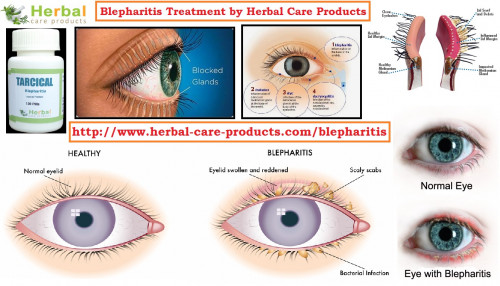 Natural-Treatment-for-Blepharitis.jpg