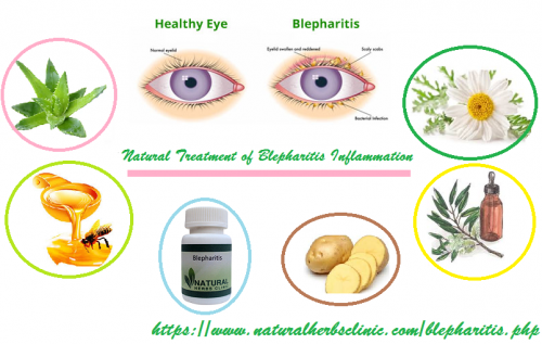 For instant relief from the symptoms of blepharitis eye inflammation, there is Natural Treatment for Blepharitis than a soothing eye mask. So these are few treatments that you must follow during blepharitis.... https://herbscareclinic.kinja.com/natural-remedies-for-blepharitis-fast-relief-1825819989