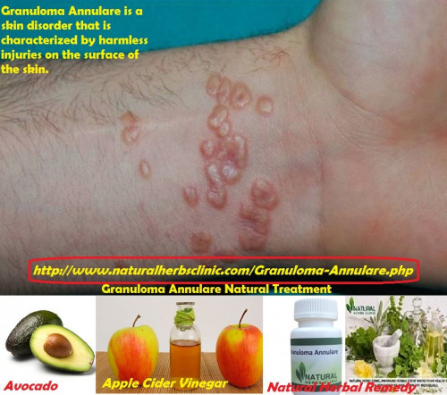 If you would prefer to save the visit to the hospital and treat yourself at home, like eczema granuloma annulare responds very well to a variety of similar Natural Treatment for Granuloma Annulare... http://granulomaannularecauses.blogspot.com/2018/05/natural-remedies-for-granuloma-annulare.html