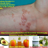 Natural-Treatment-for-Granuloma-Annularef4f6439cc6ae1309
