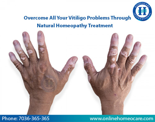 Overcome-All-Your-Vitiligo-Problems-Through-Natural-Homeopathy-Treatment.jpg