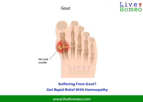 Resolve-Gouty-Arthritis-With-Homeopathy.jpg