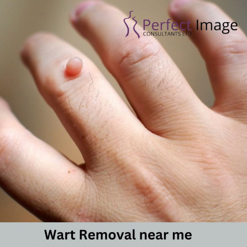 Laser Wart removal is an effective treatment. Price fee starts from £90 in London, same day treatment at our skin clinic and dermatologist.

For More Information

Visit the site: https://www.perfectimageconsultants.co.uk/

Mobile : +44 1895 630 604

Address : 2 Manor Rd, Ruislip, Middlesex HA4 7LB.

Email : info@perfectimageconsultants.co.uk

Visit our Clinic- https://maps.app.goo.gl/ssxGRVT4KP1LauMw8

Facebook Link- https://www.facebook.com/perfectimageconsultant/

Instagram- https://www.instagram.com/perfectimageconsultants/