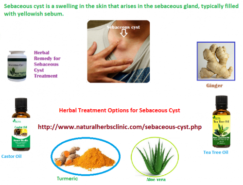 Usually, Sebaceous Cyst will not require medical treatment until they grow and become painful. In instances like this, herbal procedure may be advised by the herbalist. Herbal Treatment of Sebaceous Cyst includes the total removal of the lump using natural herbs and supplements.... http://sebaceouscyst.blogspot.com/2018/04/sebaceous-cyst-symptom-and-herbal.html