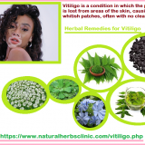 Stop-Vitiligo-with-the-Help-of-Herbal-Remedies