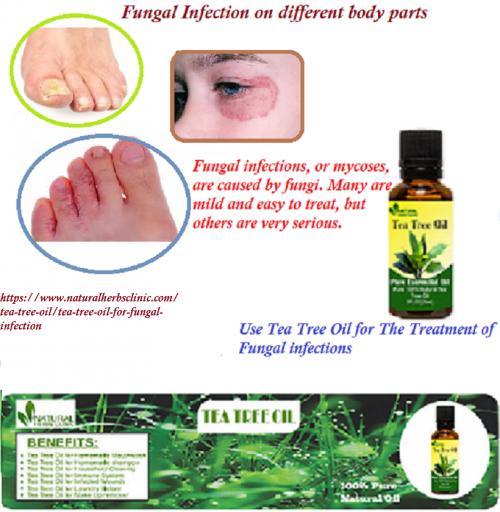 Tea-Tree-Oil-for-Fungal-Infection---Natural-Essential-Oils---Natural-Herbs-Clinic.png
