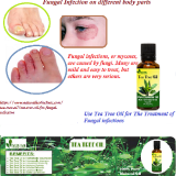 Tea-Tree-Oil-for-Fungal-Infection---Natural-Essential-Oils---Natural-Herbs-Clinic