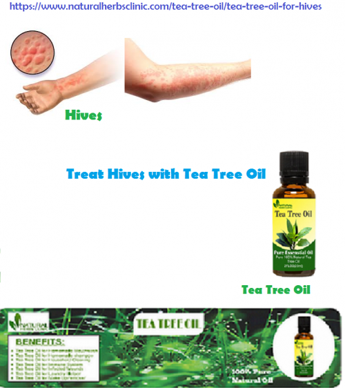 Tea Tree oil for Hives which is especially beneficial for treating hives and it creates a protective barrier on the skin, so those of you who do not resist scratching will have some leeway.... https://www.naturalherbsclinic.com/tea-tree-oil/tea-tree-oil-for-hives