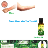 Tea-Tree-Oil-for-Hives---Natural-Essential-Oils---Natural-Herbs-Clinic