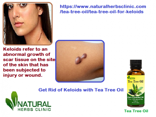 Tea Tree oil for Keloids it can help you to reduce their appearance and clear out your skin. Don’t play with Keloids it can irritate you.... https://www.naturalherbsclinic.com/tea-tree-oil/tea-tree-oil-for-keloids