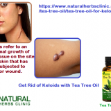 Tea-Tree-Oil-for-Keloids---Natural-Essential-Oils---Natural-Herbs-Clinic