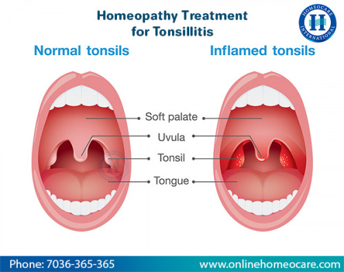 Tonsillitis