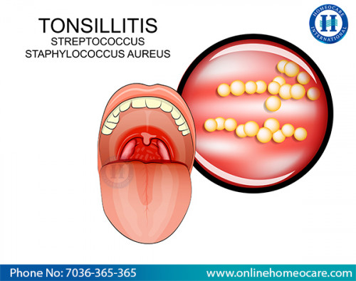 Tonsillitis(OHCI)