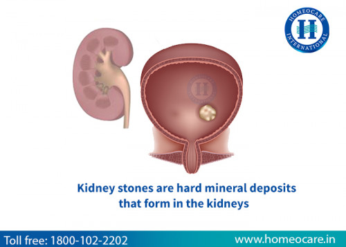 Ultimate-Homeopathy-Treatment-For-Kidney-Stones-In-Miyapur.jpg