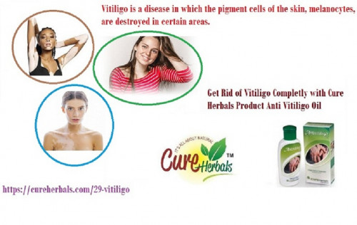 Vitiligo-Natural-Organics.jpg