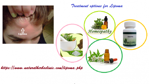 Lipoma is a type of benign tumor that is composed of adipose tissue or body fat. Such cysts are normally painless and movable.... http://naturalherbsclinic.bcz.com/2017/12/19/natural-and-herbal-treatment-for-lipoma/