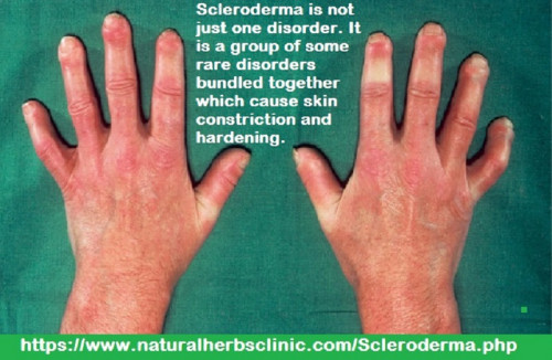 Scleroderma refers to a common disease afflicting connective tissues. Scleroderma can create deleterious changes in internal organs, muscles, blood vessels and the skin. The symptoms of the two types of Scleroderma are quite diverse... http://issclerodermagenetic.blogspot.com/2017/11/natural-remedies-for-scleroderma.html