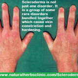 What-is-Scleroderma